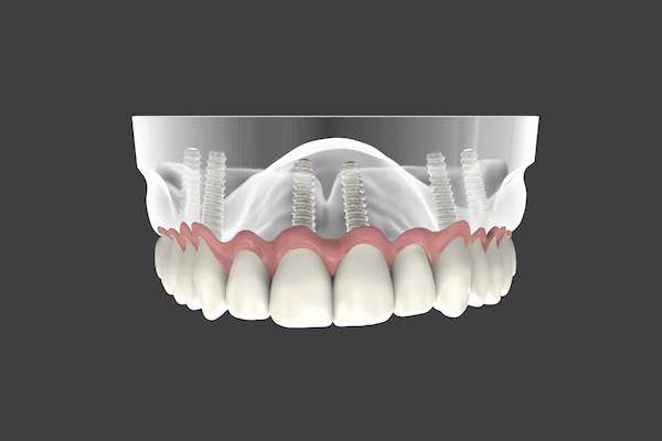 Are Implant Supported Dentures Permanent from Artisan Dental in Bellevue, WA