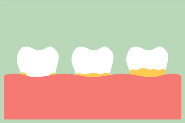 Can Plaque Buildup Cause Receding Gums?