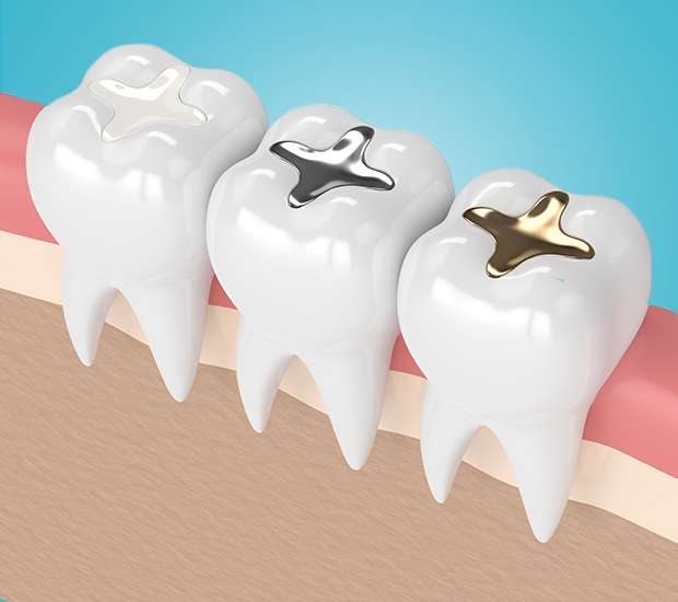 Bellevue Tooth Colored Fillings