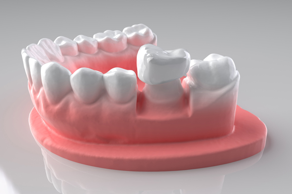 What Is The Purpose Of Dental Crowns?