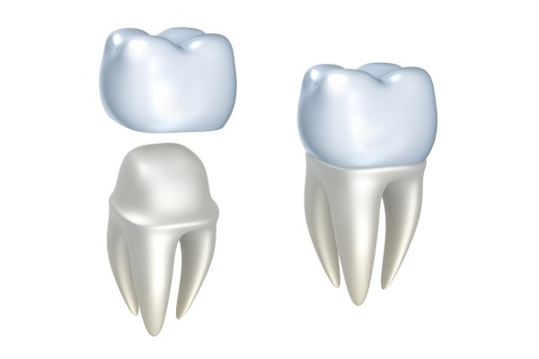 Reasons To Visit A Dental Implant Professional