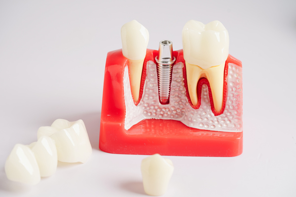 Dental Implant To Replace Single Missing Tooth