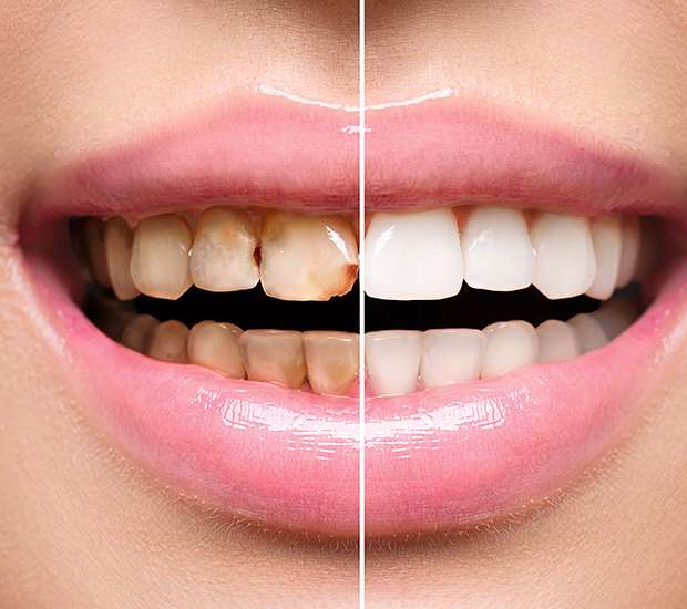 Bellevue Dental Implant Restoration