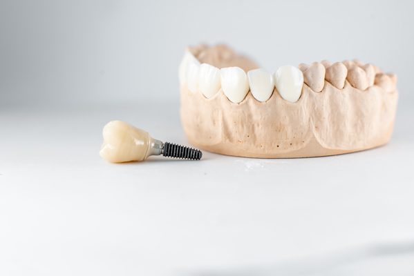 Recovery Tips After Getting Dental Implants