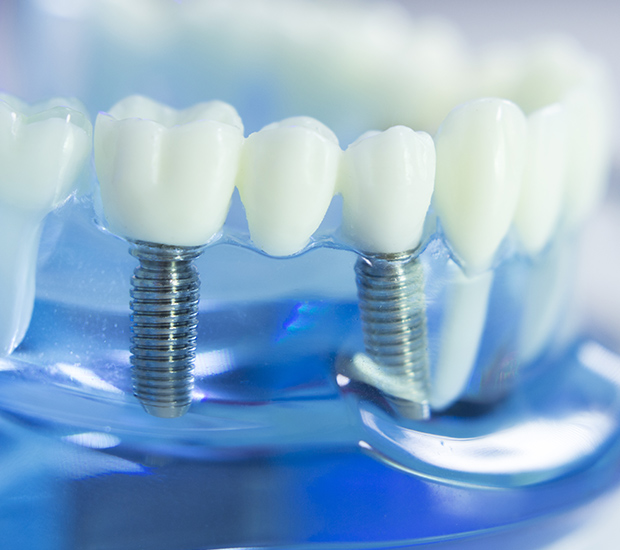 Ceramic Implants for Bellevue, WA - A Smiling Heart Dentistry - General  Dentistry