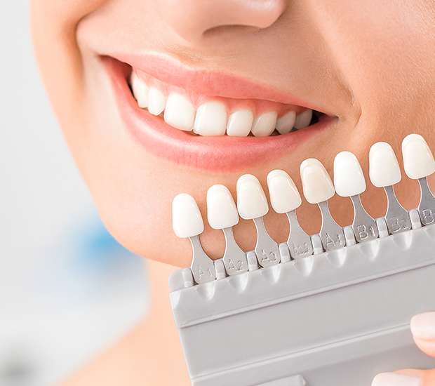 Bellevue Veneers