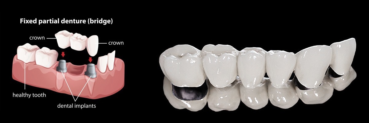 Bellevue Dentures