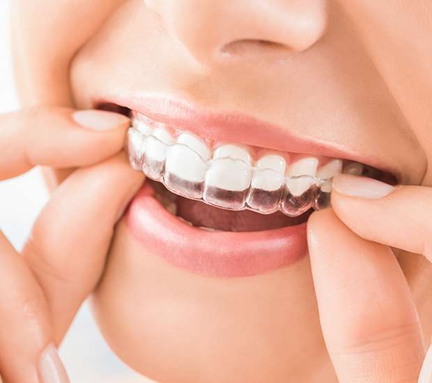 Bellevue Does Invisalign® Really Work?