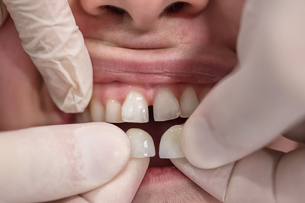 How Do Veneers Work? from Artisan Dental in Bellevue, WA
