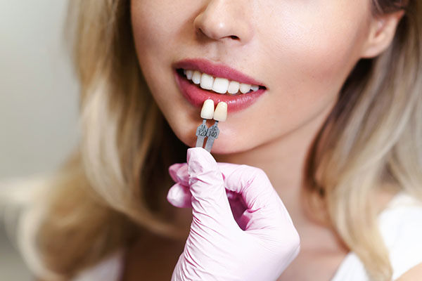 How Effective Are Dental Veneers?