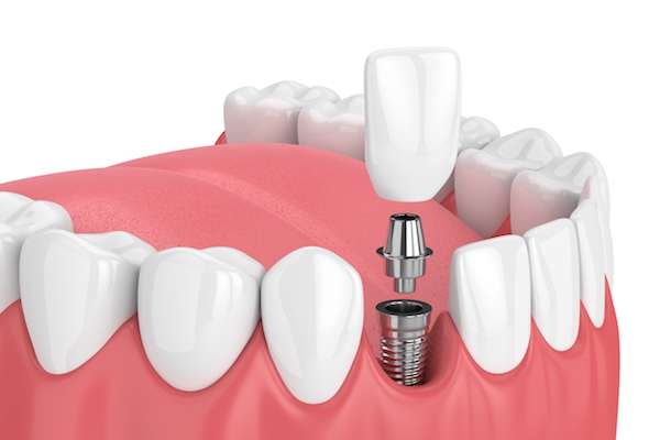 Are Dental Implants Pain After Surgery?