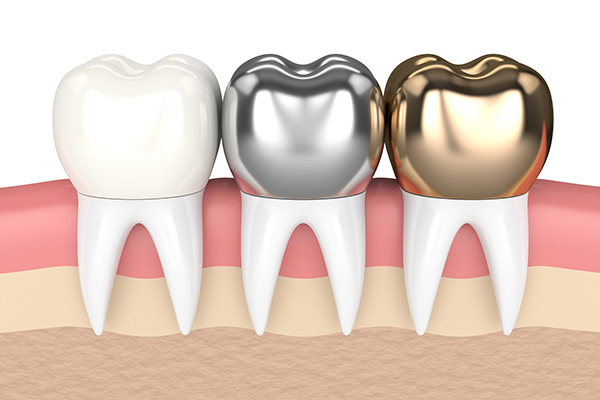 root canal metal crown