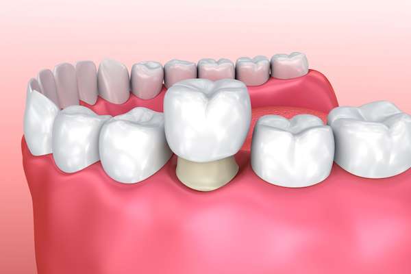 Permanent Dental Crowns Vs  Temporary: Is There A Difference