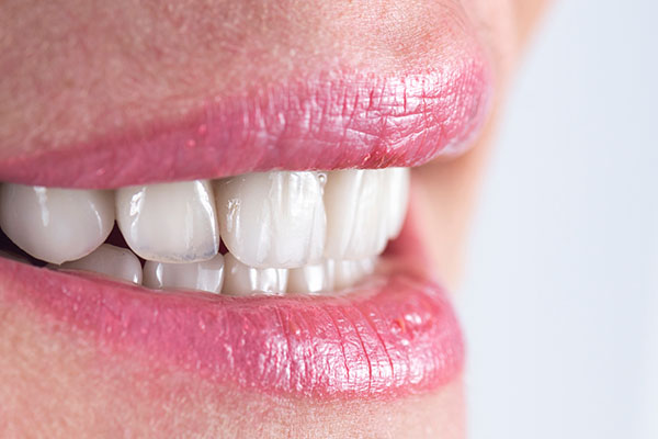 How To Prevent Cavities Under Veneers from Artisan Dental in Bellevue, WA
