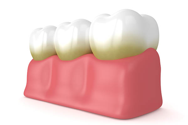 Preventative Dental Care Against Plaque And Tartar