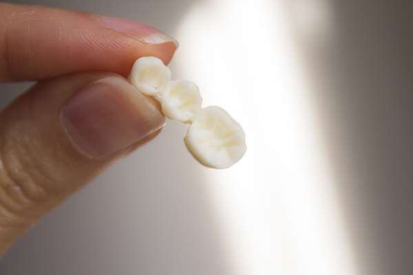 Replace Missing Teeth with Dental Bridges from Artisan Dental in Bellevue, WA