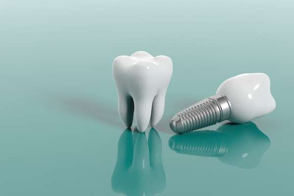 Multiple Teeth Replacement Options: One Implant for Two Teeth from Artisan Dental in Bellevue, WA