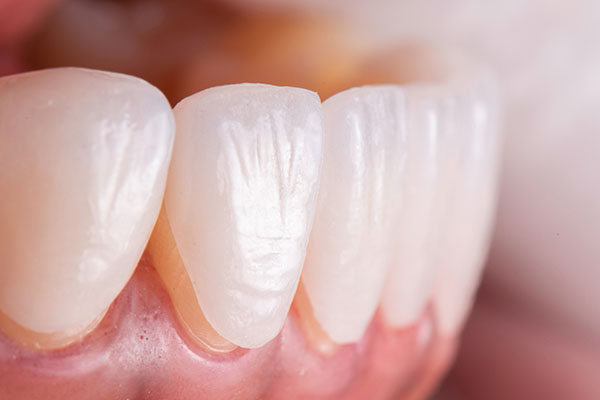 Using Veneers To Close Gaps Between Teeth from Artisan Dental in Bellevue, WA