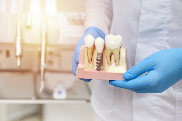 What Is The Process Of Getting A Dental Implant?