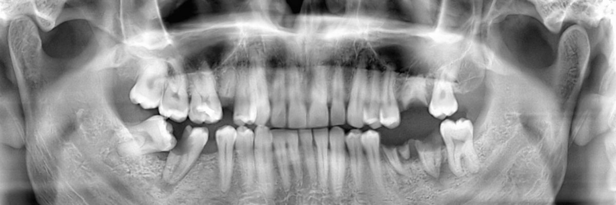 Bellevue Wisdom Teeth Extraction